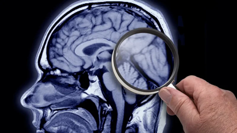 Reposição de vitamina C no cérebro “atrasa início e a progressão” da Doença de Alzheimer, conclui estudo